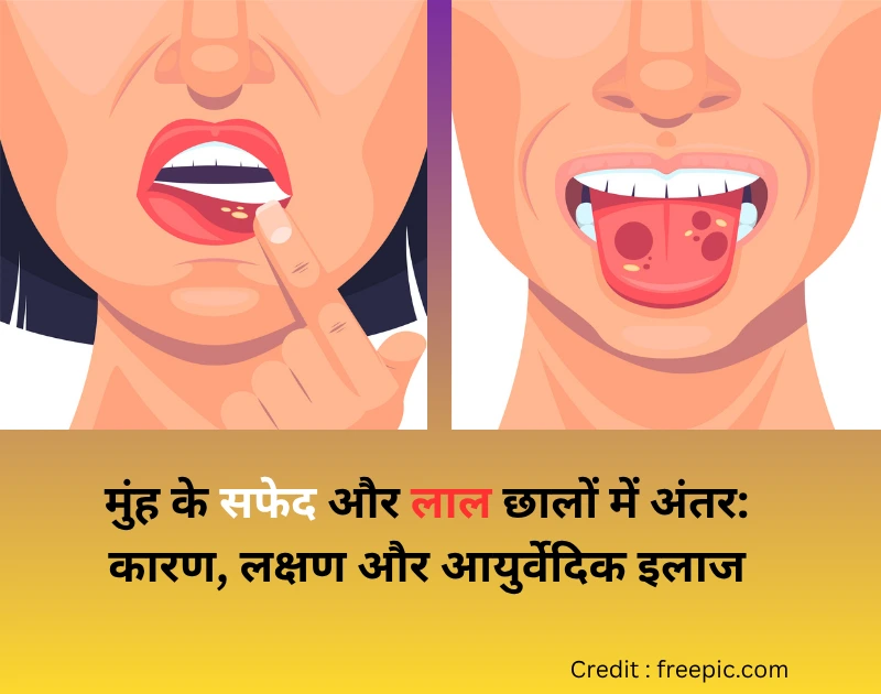 Muh ke safed aur laal chhalo ka karan antar gharelu aur ayurvedic upchar